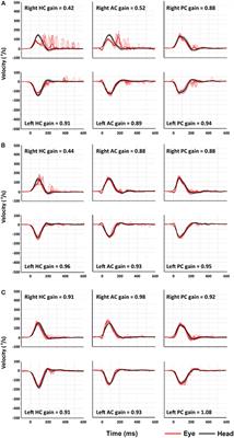 When the Room Is Spinning: Experience of Vestibular Neuritis by a Neurotologist